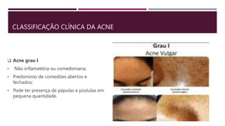 CLASSIFICAÇÃO CLÍNICA DA ACNE
 Acne grau I
• Não inflamatória ou comedoniana;
• Predomínio de comedões abertos e
fechados;
• Pode ter presença de pápulas e pústulas em
pequena quantidade.
 