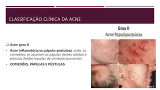 CLASSIFICAÇÃO CLÍNICA DA ACNE
 Acne grau II
• Acne inflamatória ou pápulo-pustulosa, onde, os
comedões, se associam as pápulas (lesões sólidas) e
pústulas (lesões líquidas de conteúdo purulento).
• COMEDÕES, PÁPULAS E PÚSTULAS
 