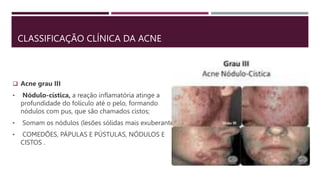 CLASSIFICAÇÃO CLÍNICA DA ACNE
 Acne grau III
• Nódulo-cística, a reação inflamatória atinge a
profundidade do folículo até o pelo, formando
nódulos com pus, que são chamados cistos;
• Somam os nódulos (lesões sólidas mais exuberantes);
• COMEDÕES, PÁPULAS E PÚSTULAS, NÓDULOS E
CISTOS .
 