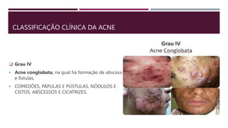 CLASSIFICAÇÃO CLÍNICA DA ACNE
 Grau IV
• Acne conglobata, na qual há formação de abscessos
e fístulas;
• COMEDÕES, PÁPULAS E PÚSTULAS, NÓDULOS E
CISTOS, ABSCESSOS E CICATRIZES.
 