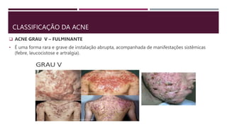 CLASSIFICAÇÃO DA ACNE
 ACNE GRAU V – FULMINANTE
• É uma forma rara e grave de instalação abrupta, acompanhada de manifestações sistêmicas
(febre, leucocistose e artralgia).
 