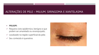 ALTERAÇÕES DE PELE – MILIUM, SIRINGOMA E XANTELASMA
 MILIUM:
 Pequeno cisto epidérmico, benigno e que
podem ser amarelado ou esranquiçado;
 Localizado na região superficial da pele;
 Seu conteúdo é queratina.
 