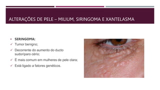 ALTERAÇÕES DE PELE – MILIUM, SIRINGOMA E XANTELASMA
 SERINGOMA:
 Tumor benigno;
 Decorrente do aumento do ducto
sudoríparo cério;
 É mais comum em mulheres de pele clara;
 Está ligado a fatores genéticos.
 