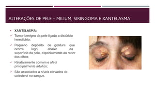 ALTERAÇÕES DE PELE – MILIUM, SIRINGOMA E XANTELASMA
 XANTELASMA:
 Tumor benigno da pele ligado a distúrbio
hereditário;
 Pequeno depósito de gordura que
ocorre logo abaixo da
superfície da pele, especialmente ao redor
dos olhos;
 Relativamente comum e afeta
principalmente adultos;
 São associados a níveis elevados de
colesterol no sangue.
 