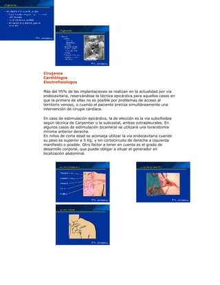 Cirujanos
Cardiólogos
Electrofisiologos
Más del 95% de las implantaciones se realizan en la actualidad por vía
endocavitaria, reservándose la técnica epicárdica para aquellos casos en
que la primera de ellas no es posible por problemas de acceso al
territorio venoso, o cuando el paciente precisa simultáneamente una
intervención de cirugía cardíaca.
En caso de estimulación epicárdica, la de elección es la vía subxifoidea
según técnica de Carpentier o la subcostal, ambas extrapleurales. En
algunos casos de estimulación bicameral se utilizará una toracotomía
mínima anterior derecha.
En niños de corta edad se aconseja utilizar la vía endocavitaria cuando
su peso es superior a 5 Kg. y sin cortocircuito de derecha a izquierda
manifiesto o posible. Otro factor a tener en cuenta es el grado de
desarrollo corporal, que puede obligar a situar el generador en
localización abdominal.
 