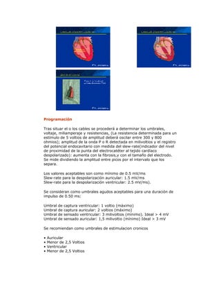 Programación
Tras situar el o los cables se procederá a determinar los umbrales,
voltaje, miliamperaje y resistencias, (La resistencia determinada para un
estímulo de 5 voltios de amplitud deberá oscilar entre 300 y 800
ohmios); amplitud de la onda P o R detectada en milivoltios y el registro
del potencial endocavitario con medida del slew-rate(indicador del nivel
de proximidad de la punta del electrocatéter al tejido cardíaco
despolarizado): aumenta con la fibrosis,y con el tamaño del electrodo.
Se mide dividiendo la amplitud entre picos por el intervalo que los
separa.
Los valores aceptables son como mínimo de 0.5 mV/ms
Slew-rate para la despolarización auricular: 1.5 mV/ms
Slew-rate para la despolarización ventricular: 2.5 mV/ms).
Se consideran como umbrales agudos aceptables para una duración de
impulso de 0.50 ms:
Umbral de captura ventricular: 1 voltio (máximo)
Umbral de captura auricular: 2 voltios (máximo)
Umbral de sensado ventricular: 3 milivoltios (mínimo). Ideal > 4 mV
Umbral de sensado auricular: 1,5 milivoltio (mínimo) Ideal > 3 mV
Se recomiendan como umbrales de estimulacion cronicos
• Auricular
• Menor de 2,5 Voltios
• Ventricular
• Menor de 2,5 Voltios
 