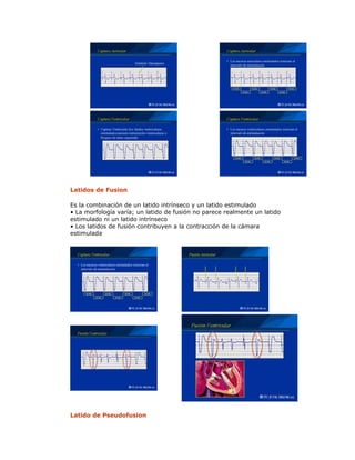 Latidos de Fusion
Es la combinación de un latido intrínseco y un latido estimulado
• La morfología varía; un latido de fusión no parece realmente un latido
estimulado ni un latido intrínseco
• Los latidos de fusión contribuyen a la contracción de la cámara
estimulada
Latido de Pseudofusion
 