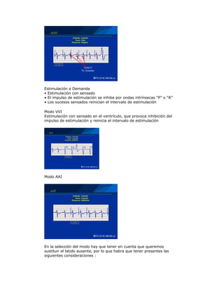 Estimulación a Demanda
• Estimulación con sensado
• El impulso de estimulación se inhibe por ondas intrínsecas “P” o “R”
• Los sucesos sensados reinician el intervalo de estimulación
Modo VVI
Estimulación con sensado en el ventrículo, que provoca inhibición del
impulso de estimulación y reinicia el intervalo de estimulación
Modo AAI
En la selección del modo hay que tener en cuenta que queremos
sustituir el latido ausente, por lo que habra que tener presentes las
siguientes consideraciones :
 