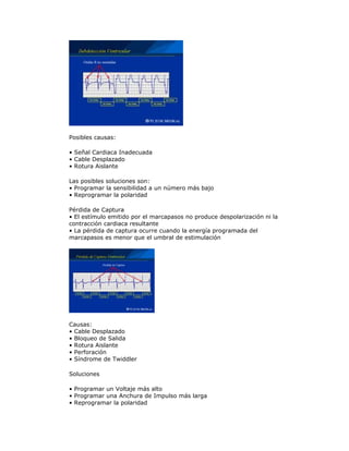 Posibles causas:
• Señal Cardiaca Inadecuada
• Cable Desplazado
• Rotura Aislante
Las posibles soluciones son:
• Programar la sensibilidad a un número más bajo
• Reprogramar la polaridad
Pérdida de Captura
• El estímulo emitido por el marcapasos no produce despolarización ni la
contracción cardiaca resultante
• La pérdida de captura ocurre cuando la energía programada del
marcapasos es menor que el umbral de estimulación
Causas:
• Cable Desplazado
• Bloqueo de Salida
• Rotura Aislante
• Perforación
• Síndrome de Twiddler
Soluciones
• Programar un Voltaje más alto
• Programar una Anchura de Impulso más larga
• Reprogramar la polaridad
 