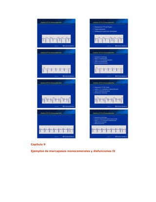 Capitulo 9
Ejemplos de marcapasos monocamerales y disfunciones II
 