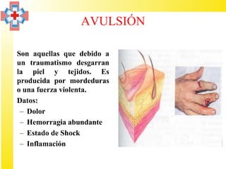 AVULSIÓN

• Son aquellas que debido a
  un traumatismo desgarran
  la piel y tejidos. Es
  producida por mordeduras
  o una fuerza violenta.
• Datos:
   – Dolor
   – Hemorragia abundante
   – Estado de Shock
   – Inflamación
 