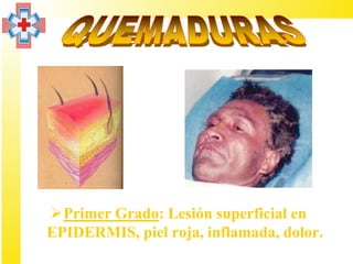 Primer Grado: Lesión superficial en
EPIDERMIS, piel roja, inflamada, dolor.
 