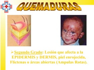 Segundo Grado: Lesión que afecta a la
 EPIDERMIS y DERMIS, piel enrojecida,
Flictenas o áreas abiertas (Ampulas Rotas).
 