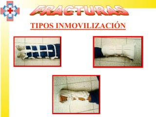 TIPOS INMOVILIZACIÓN
 