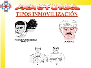 TIPOS INMOVILIZACIÓN
 