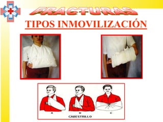 TIPOS INMOVILIZACIÓN
 