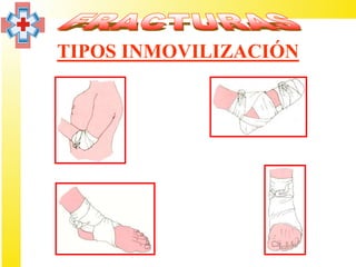TIPOS INMOVILIZACIÓN
 