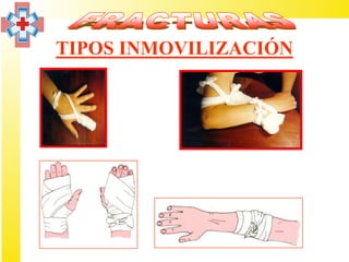TIPOS INMOVILIZACIÓN
 