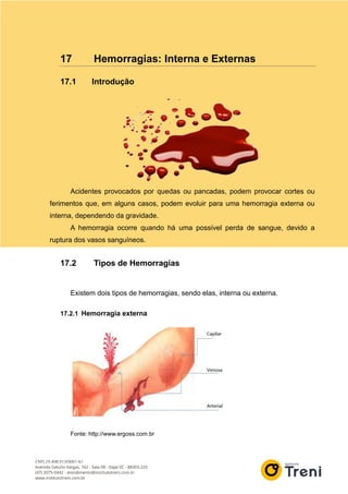 17 Hemorragias: Interna e Externas
17.1 Introdução
Acidentes provocados por quedas ou pancadas, podem provocar cortes ou
ferimentos que, em alguns casos, podem evoluir para uma hemorragia externa ou
interna, dependendo da gravidade.
A hemorragia ocorre quando há uma possível perda de sangue, devido a
ruptura dos vasos sanguíneos.
17.2 Tipos de Hemorragias
Existem dois tipos de hemorragias, sendo elas, interna ou externa.
17.2.1 Hemorragia externa
Fonte: http://www.ergoss.com.br
 