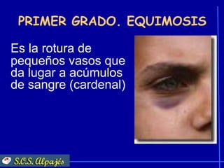PRIMER GRADO. EQUIMOSIS

Es la rotura de
pequeños vasos que
da lugar a acúmulos
de sangre (cardenal)
 