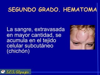 SEGUNDO GRADO. HEMATOMA


La sangre, extravasada
en mayor cantidad, se
acumula en el tejido
celular subcutáneo
(chichón)
 