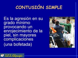 CONTUSIÓN SIMPLE

Es la agresión en su
grado mínimo
provocando un
enrojecimiento de la
piel, sin mayores
complicaciones
(una bofetada)
 