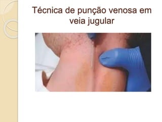 Técnica de punção venosa em
veia jugular
 