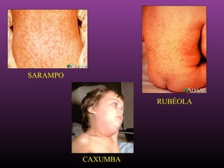 SARAMPO RUBÉOLA CAXUMBA 