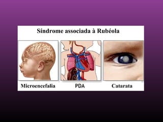 Síndrome associada à Rubéola Microencefalia Catarata 