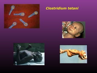 Clostridium tetani  