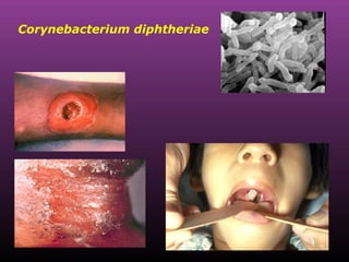 Corynebacterium diphtheriae  