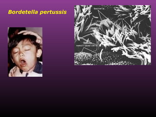 Bordetella pertussis 
