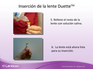 5. Rellene el resto de la lente con solución salina. 6.  La lente está ahora lista para su inserción. Inserción de la lente Duette TM 