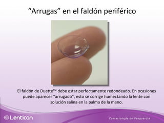 El faldón de Duette   debe estar perfectamente redondeado. En ocasiones puede aparecer “arrugado”, esto se corrige humectando la lente con solución salina en la palma de la mano. “ Arrugas” en el faldón periférico 