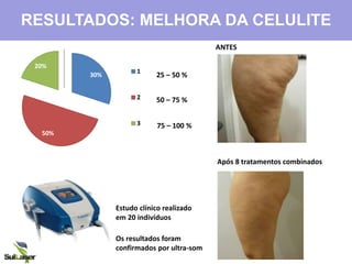 30%
50%
20%
0%
1
2
3
25 – 50 %
50 – 75 %
75 – 100 %
Estudo clínico realizado
em 20 indivíduos
Os resultados foram
confirmados por ultra-som
RESULTADOS: MELHORA DA CELULITE
ANTES
Após 8 tratamentos combinados
 