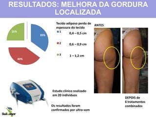 35%
40%
25%
0%
1
2
3
0,4 – 0,5 cm
0,6 – 0,9 cm
1 – 1,2 cm
RESULTADOS: MELHORA DA GORDURA
LOCALIZADA
Estudo clínico realizado
em 20 indivíduos
Tecido adiposo perda de
espessura do tecido
Os resultados foram
confirmados por ultra-som
ANTES
DEPOIS de
6 tratamentos
combinados
 
