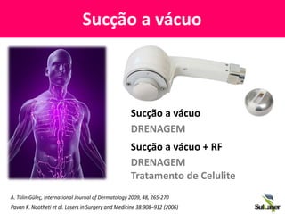 Sucção a vácuo
Sucção a vácuo
DRENAGEM
Sucção a vácuo + RF
DRENAGEM
Tratamento de Celulite
A. Tülin Güleç, International Journal of Dermatology 2009, 48, 265-270
Pavan K. Nootheti et al. Lasers in Surgery and Medicine 38:908–912 (2006)
 