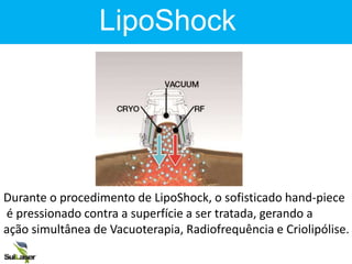 LIPOSHOCK
Durante o procedimento de LipoShock, o sofisticado hand-piece
é pressionado contra a superfície a ser tratada, gerando a
ação simultânea de Vacuoterapia, Radiofrequência e Criolipólise.
LipoShock
 