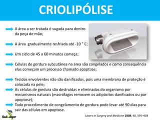 A área a ser tratada é sugada para dentro
da peça de mão;
A área gradualmente resfriada até -10 ° C;
Um ciclo de 45 a 60 minutos começa;
Células de gordura subcutânea na área são congelados e como consequência
elas começam um processo chamado apoptose;
Tecidos envolventes não são danificados, pois uma membrana de proteção é
colocada na pele;
As células de gordura são destruídas e eliminadas do organismo por
mecanismos naturais (macrófagos removem os adipócitos danificados ou por
apoptose);
Todo procedimento de congelamento de gordura pode levar até 90 dias para
sair das células em apoptose.
CoaxMed is the most advanced body
workstation, combining several techno
olar RF 850KHz
nopolar RF From 300KHz to 1 MHz
minal energy up to 350 Watt
asound 28 KHz
minal energy up to 100 Watt
o - 20°
e duration continuos/ pulsed
ximum vacuum rate 40 lt per minute
er rate 220 - 110 VAC ± 10%
, 60 Hz
ension 740 x 560 x 1360 mm
ght 50 Kg
AX MED
THE BOD
CoaxMed Fusiom
CoaxMed, head of the fam
CRIOLIPÓLISE
Lasers in Surgery and Medicine 2008; 40, 595–604
 