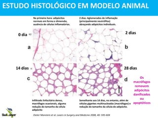 0 dia
14 dias
2 dias
28 dias
Os
macrófagos
removem
adipócitos
danificados
ou
apoptóticos
ESTUDO HISTOLÓGICO EM MODELO ANIMAL
Infiltrado linfocitário denso,
macrófagos ocasionais, alguma
redução do tamanho da célula
adipócito
Semelhante aos 14 dias, no entanto, além de
células gigantes multinucleadas (macrófagos) e
redução do tamanho da célula do adipócito.
Na primeira hora: adipócitos
normais em forma e dimensão,
ausência de células inflamatórias.
2 dias: Aglomerados de inflamação
(principalmente neutrófilos)
abraçando adipócitos individuais.
Dieter Manstein et al. Lasers in Surgery and Medicine 2008, 40: 595-604
 