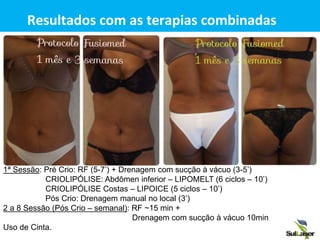 Resultados com as terapias combinadas
1ª Sessão: Pré Crio: RF (5-7’) + Drenagem com sucção à vácuo (3-5’)
CRIOLIPÓLISE: Abdômen inferior – LIPOMELT (6 ciclos – 10’)
CRIOLIPÓLISE Costas – LIPOICE (5 ciclos – 10’)
Pós Crio: Drenagem manual no local (3’)
2 a 8 Sessão (Pós Crio – semanal): RF ~15 min +
Drenagem com sucção à vácuo 10min
Uso de Cinta.
 