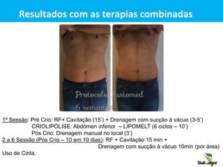 Resultados com as terapias combinadas
1ª Sessão: Pré Crio: RF+ Cavitação (15’) + Drenagem com sucção à vácuo (3-5’)
CRIOLIPÓLISE: Abdômen inferior – LIPOMELT (6 ciclos – 10’)
Pós Crio: Drenagem manual no local (3’)
2 a 6 Sessão (Pós Crio – 10 em 10 dias): RF + Cavitação 15 min +
Drenagem com sucção à vácuo 10min (por área)
Uso de Cinta.
 