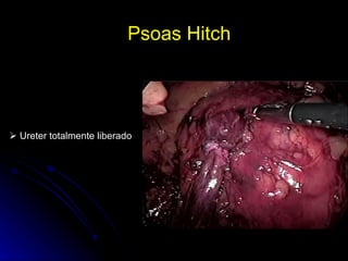 Psoas Hitch     Ureter totalmente liberado 