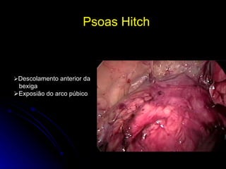 Psoas Hitch   Descolamento anterior da bexiga  Exposião do arco púbico 