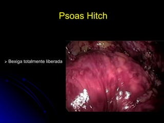 Psoas Hitch     Bexiga totalmente liberada 
