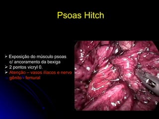 Psoas Hitch  Exposição do músculo psoas c/ ancoramento da bexiga 2 pontos vicryl 0. Atenção – vasos ilíacos e nervo gênito - femural 