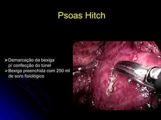 Psoas Hitch   Demarcação da bexiga p/ confecção do túnel  Bexiga preenchida com 250 ml de soro fisiológico 