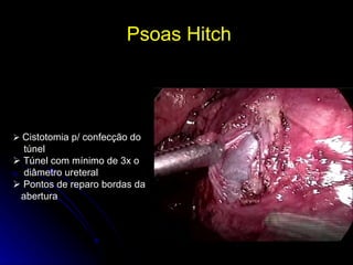 Psoas Hitch     Cistotomia p/ confecção do  túnel    Túnel com mínimo de 3x o  diâmetro ureteral    Pontos de reparo bordas da  abertura 