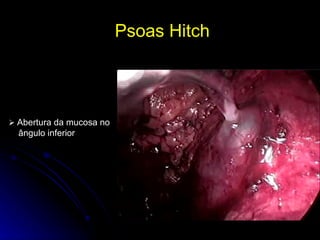 Psoas Hitch     Abertura da mucosa no  ângulo inferior   