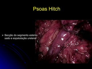 Psoas Hitch     Secção do segmento esteno- sado e espatulação ureteral 